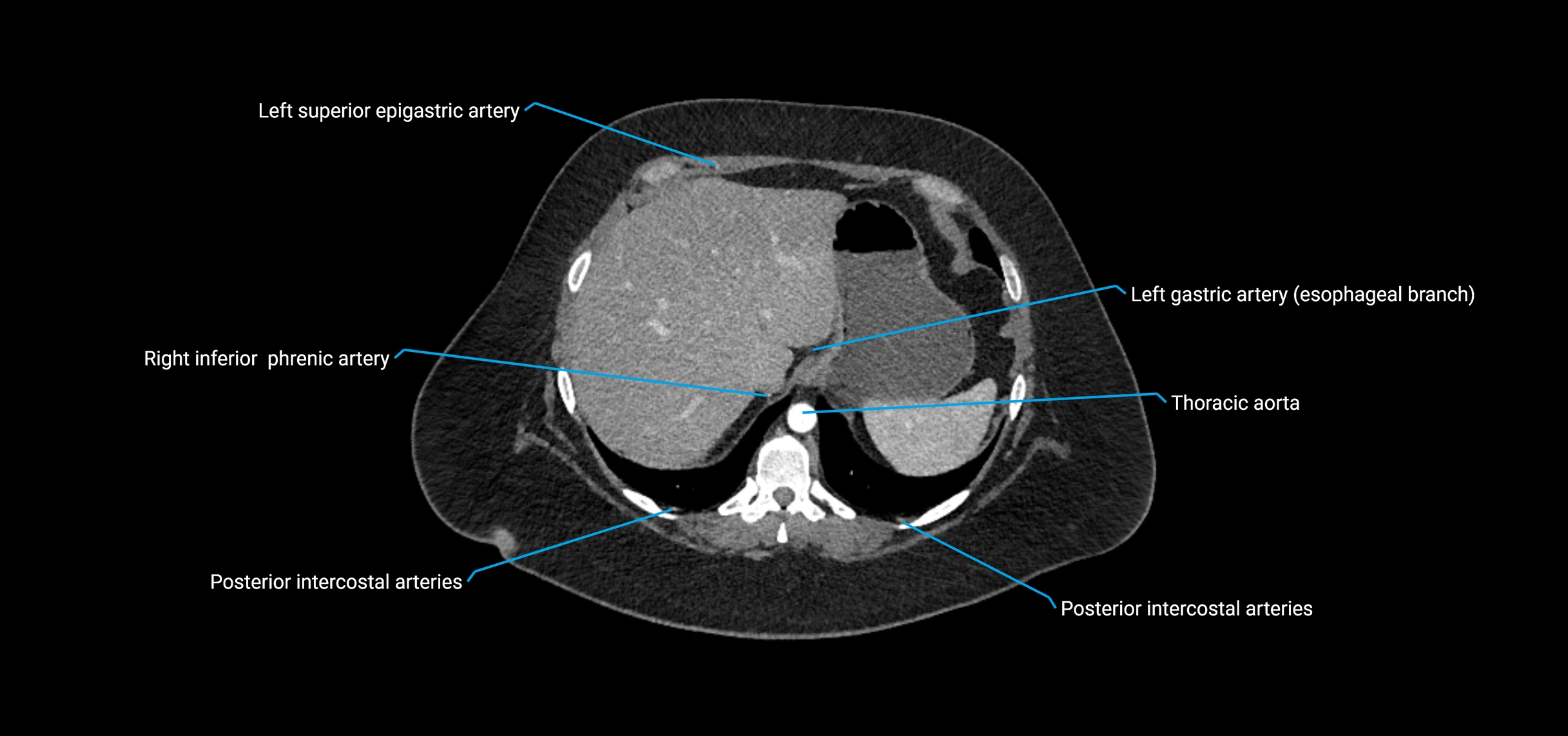 CTA abdomen axial cross sectional anatomy labelled image_29 (2).webp